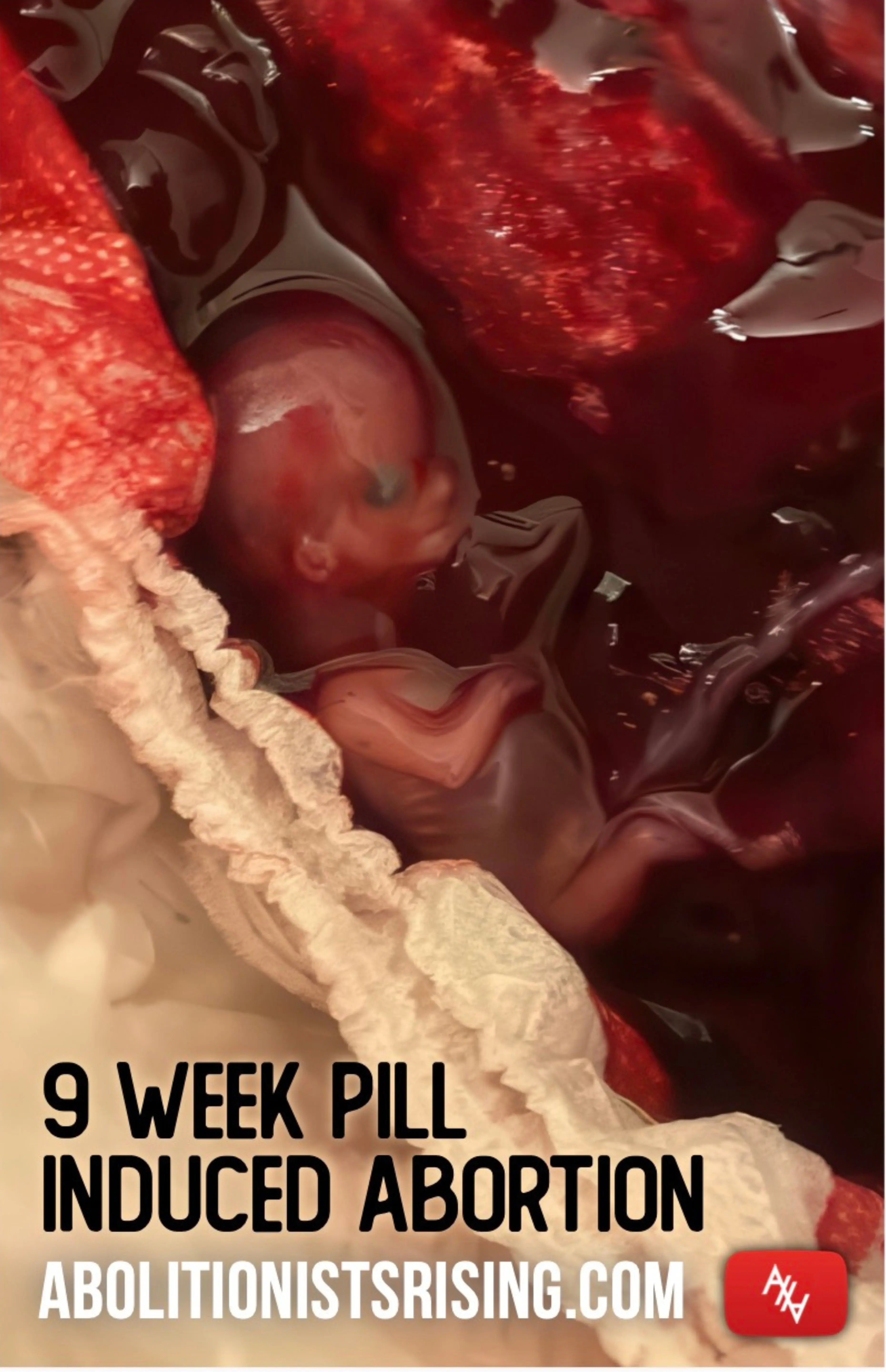 9 Week Pill Induced Abortion Sign Abolitionists Rising Store