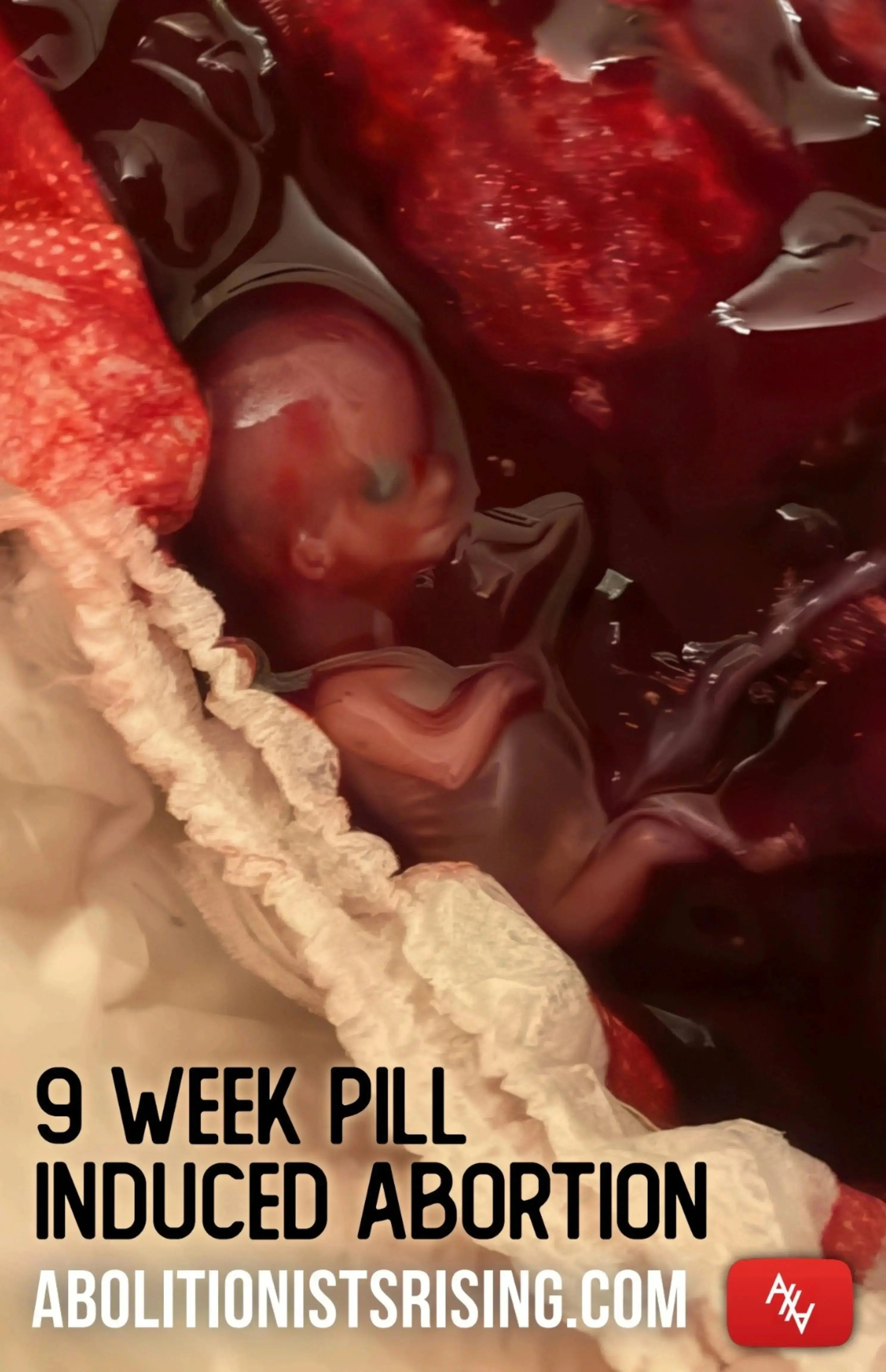 9 Week Pill Induced Abortion Abolitionists Rising Store