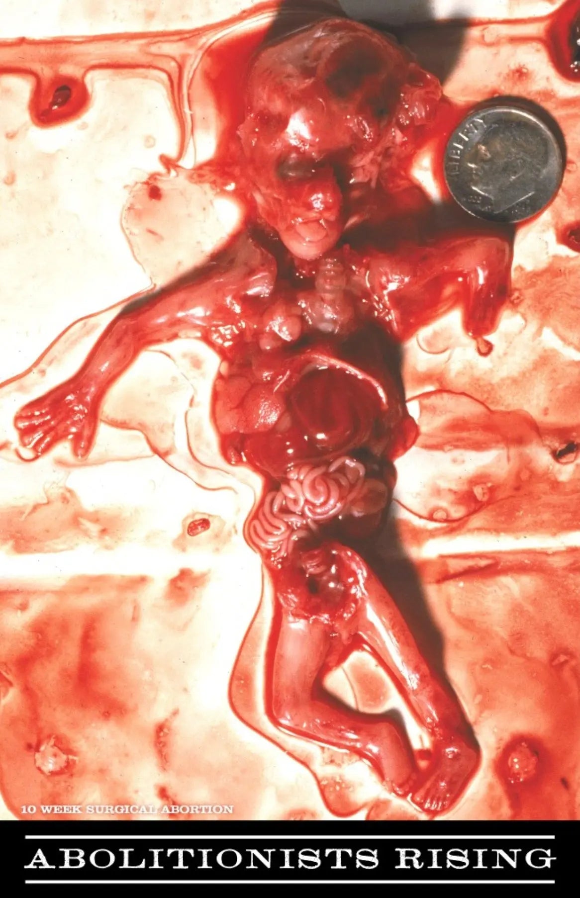 10 Weeks Surgical Abortion Victim Sign Abolitionists Rising Store 
