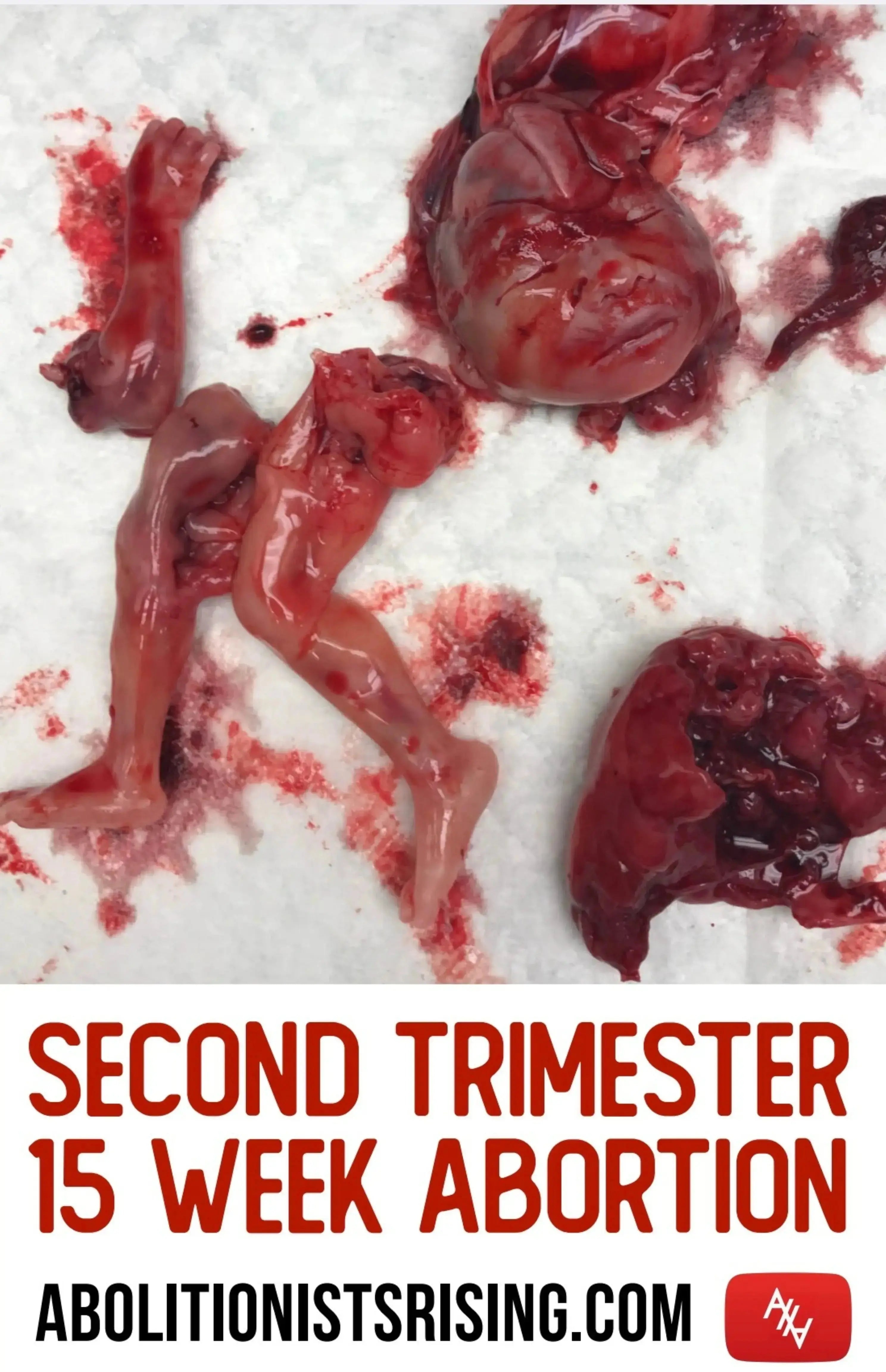 Second Trimester 15 Weeks Abortion Sign Abolitionists Rising Store 