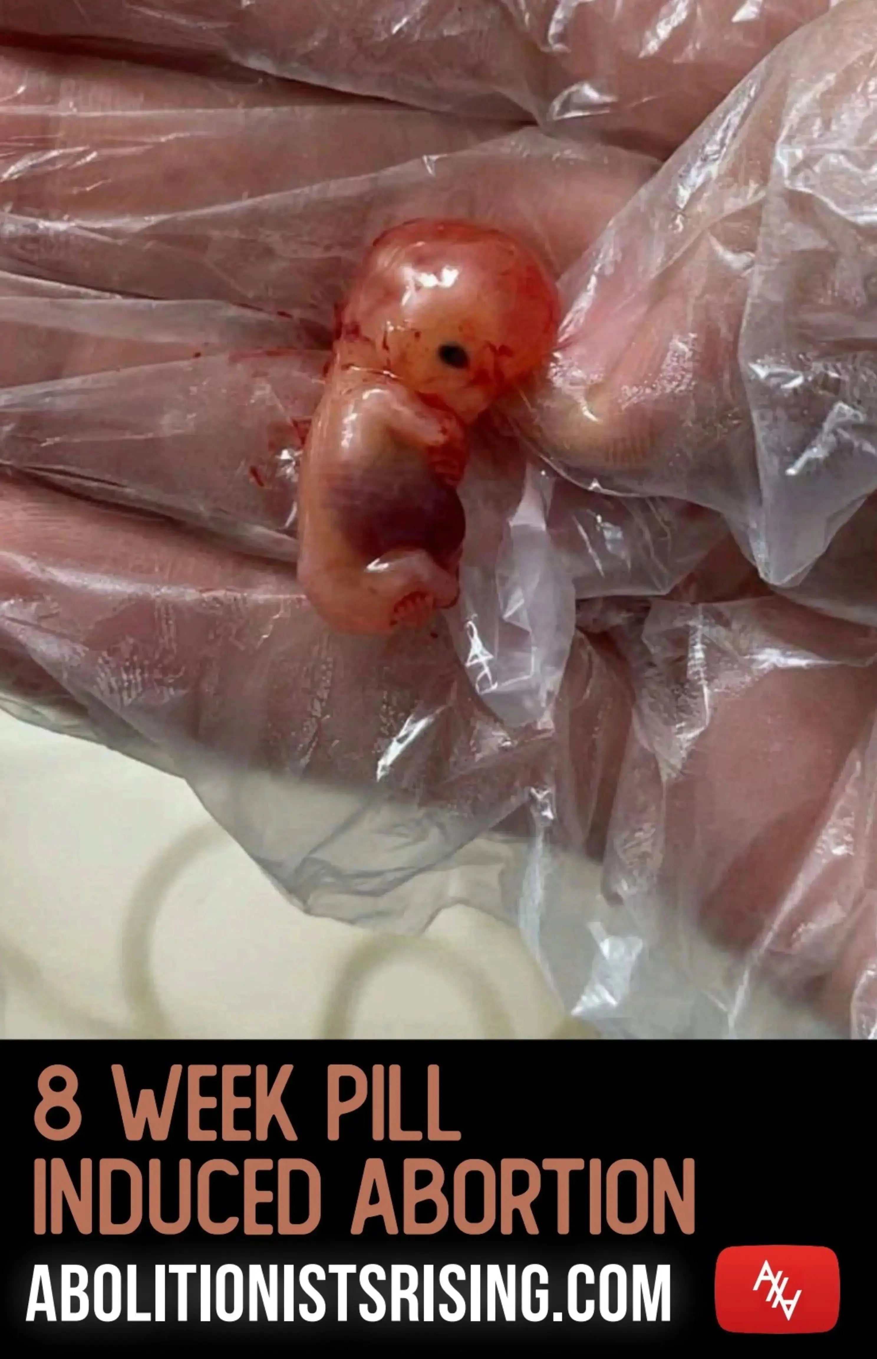 8 Week Pill Induced Abortion Abolitionists Rising Store 