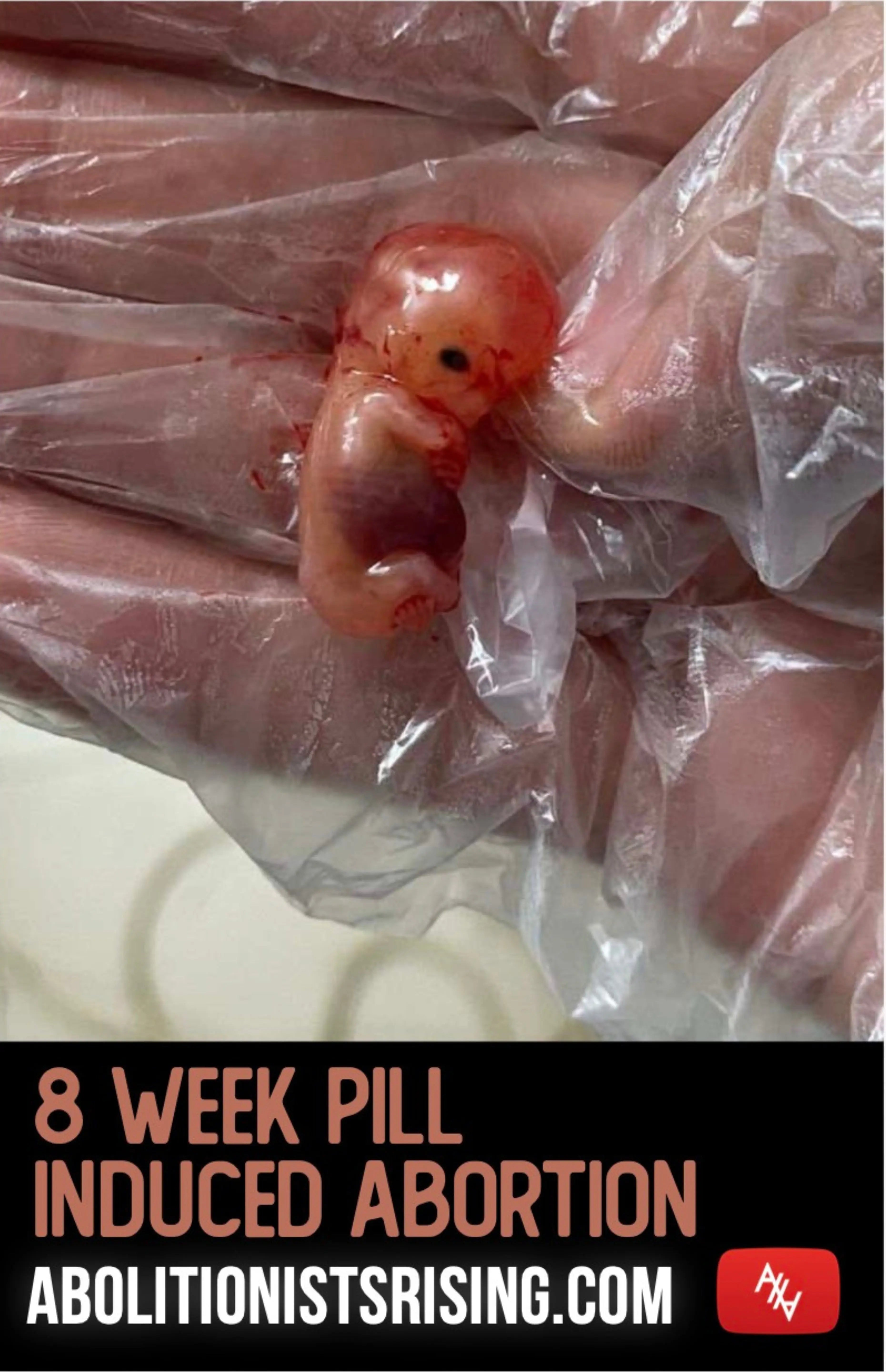 8 Week Pill Induced Abortion Sign Abolitionists Rising Store 