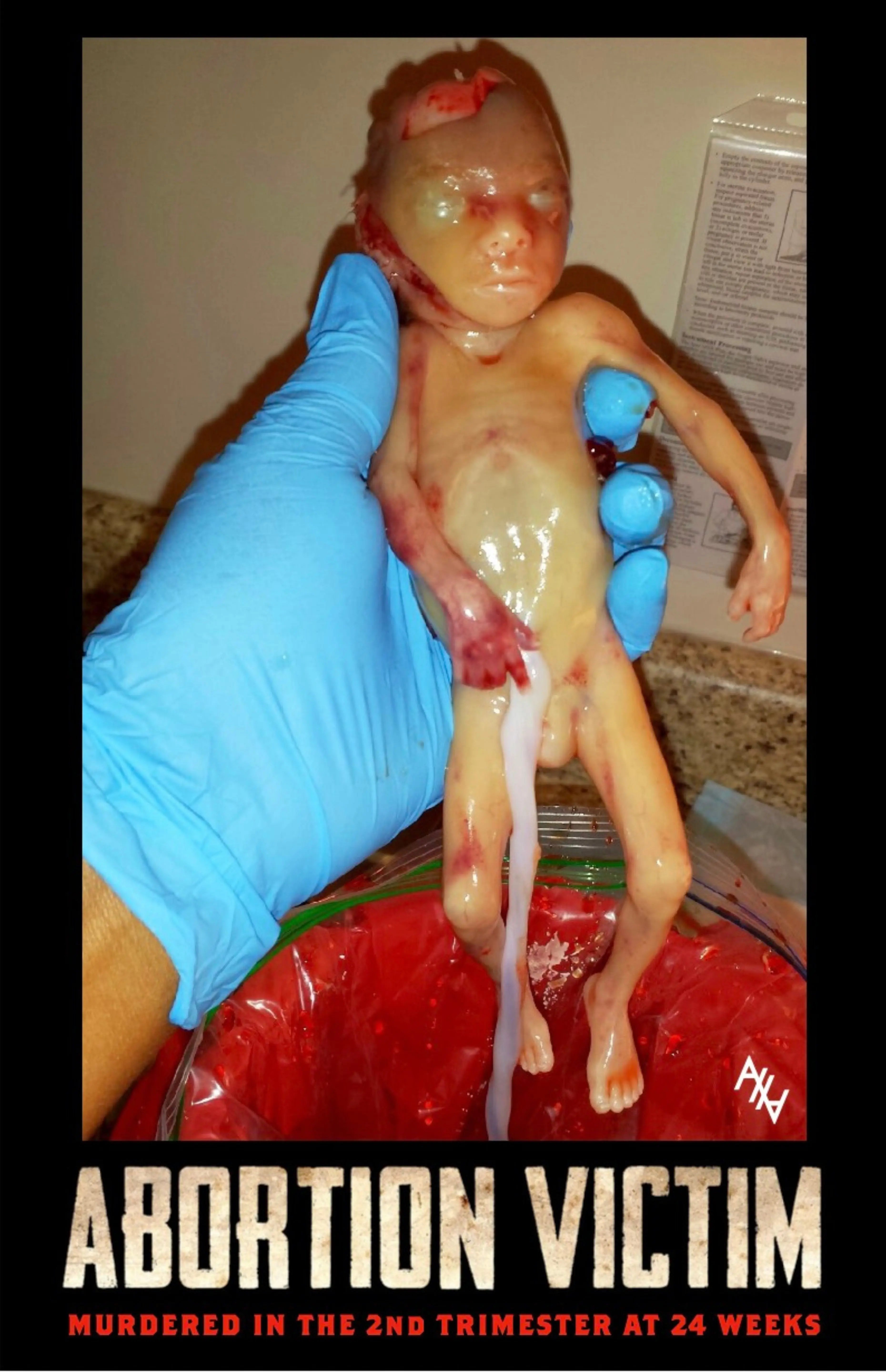 Abo. Victim 2nd Trimester 24 Weeks Sign Abolitionists Rising Store 